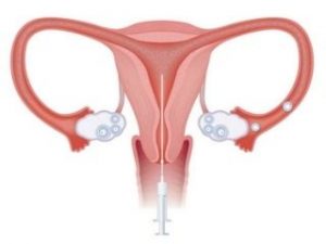 Read more about the article What is Pelvic Inflammatory Disease and how to Overcome it?