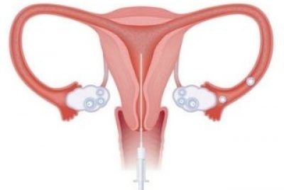 What is Polycystic Ovarian Disease? It’s Cause, Treatment and Complication