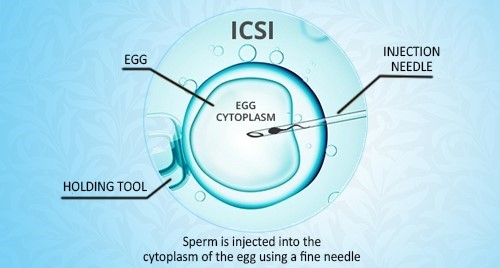 Best ICSI Treatment in Delhi, Procedure, Cost | RiSAA IVF