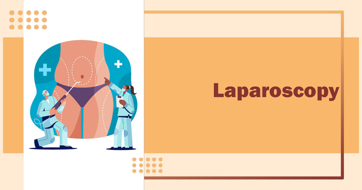 Laparoscopy