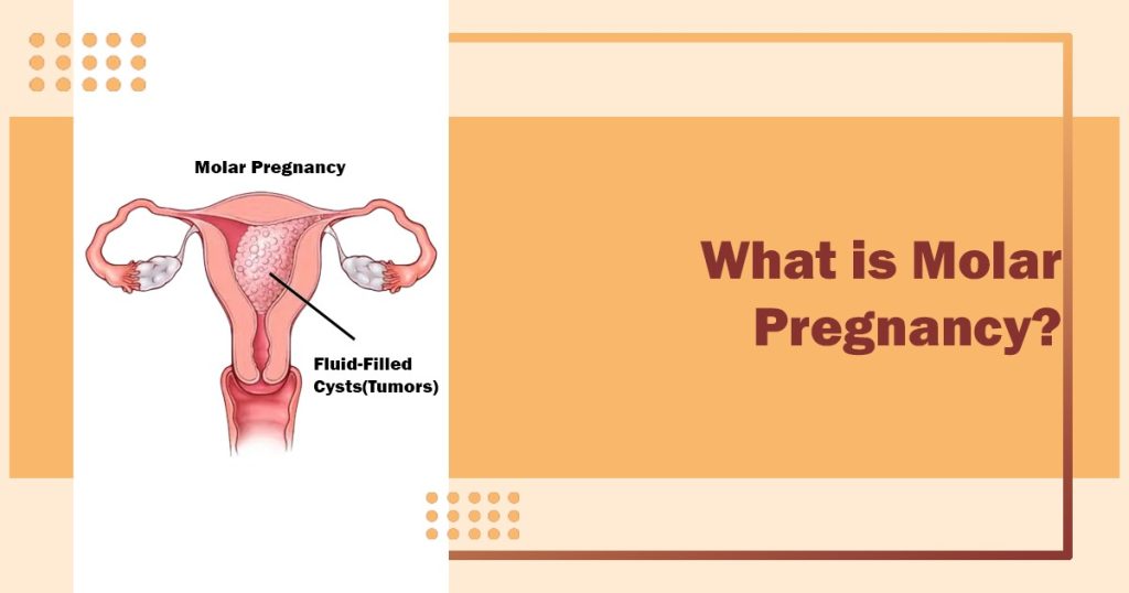 Molar Pregnancy: Symptoms, Causes, and Treatment