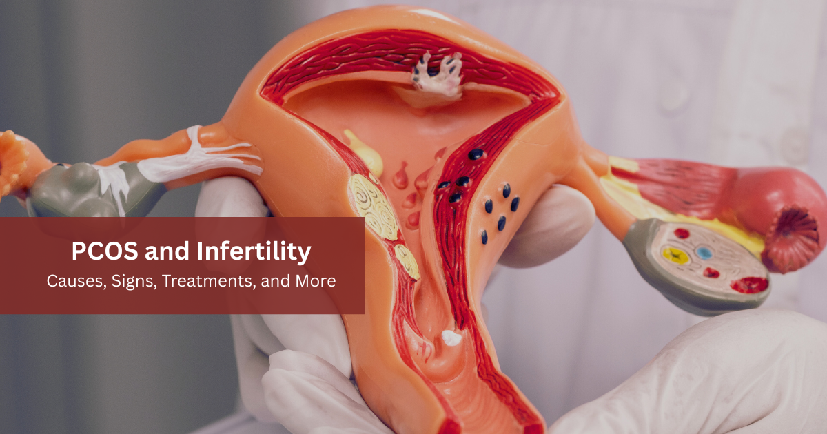 PCOS and infertility 