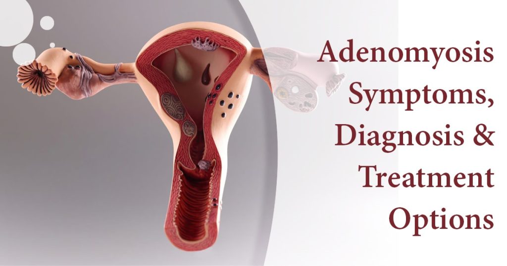 Adenomyosis Symptoms
