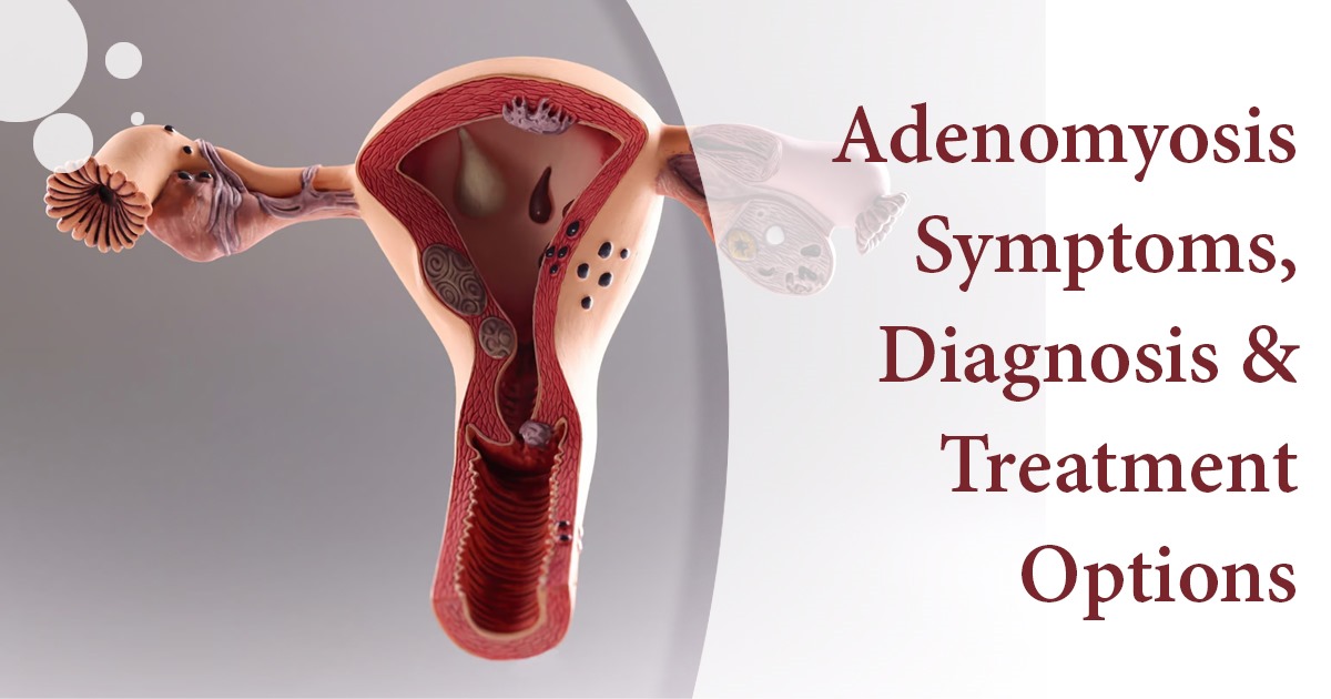 Adenomyosis Symptoms