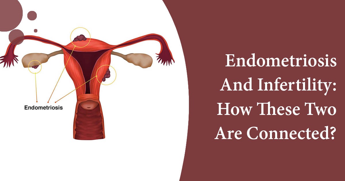 Endometriosis And Infertility