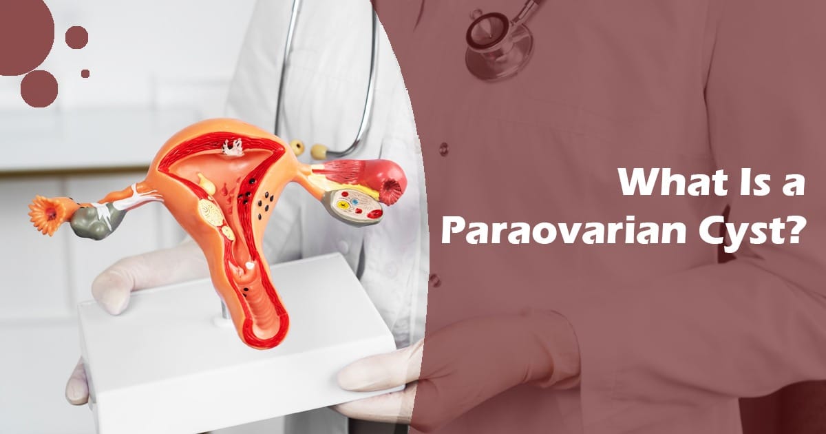 What Is a Paraovarian Cyst